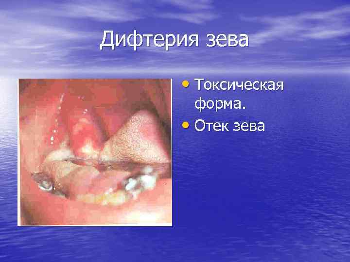 Дифтерия зева • Токсическая форма. • Отек зева 