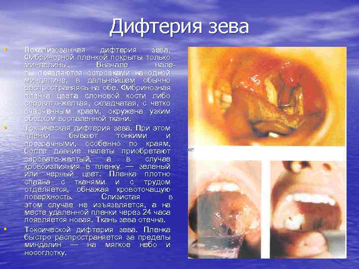 Дифтерия зева • • • Локализованная дифтерия зева. Фибринозной пленкой покрыты только миндалины. Вначале