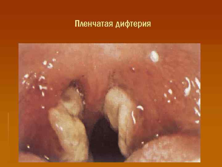Пленчатая дифтерия 