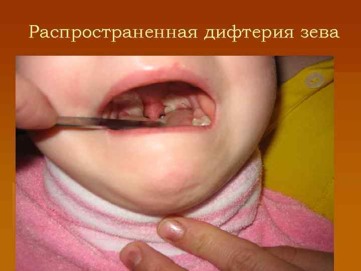 Распространенная дифтерия зева 