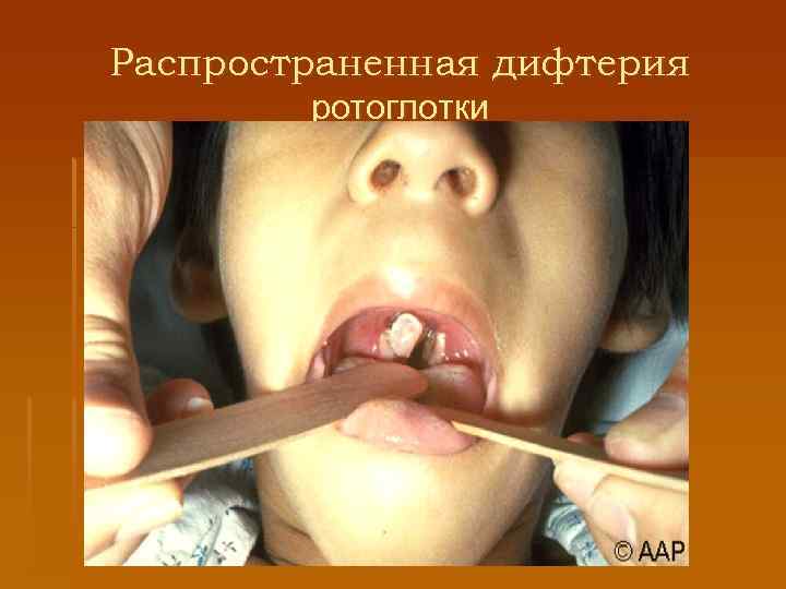 Распространенная дифтерия ротоглотки 