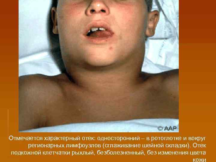 Отмечается характерный отек: односторонний – в ротоглотке и вокруг регионарных лимфоузлов (сглаживание шейной складки).