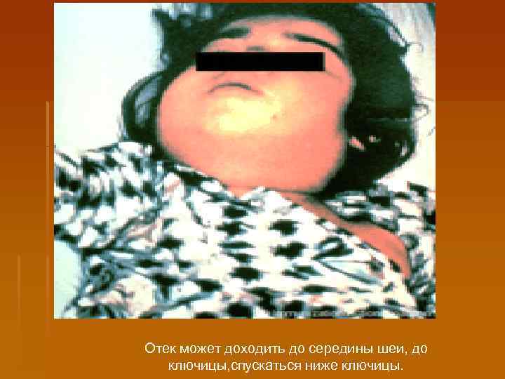 Отек может доходить до середины шеи, до ключицы, спускаться ниже ключицы. 