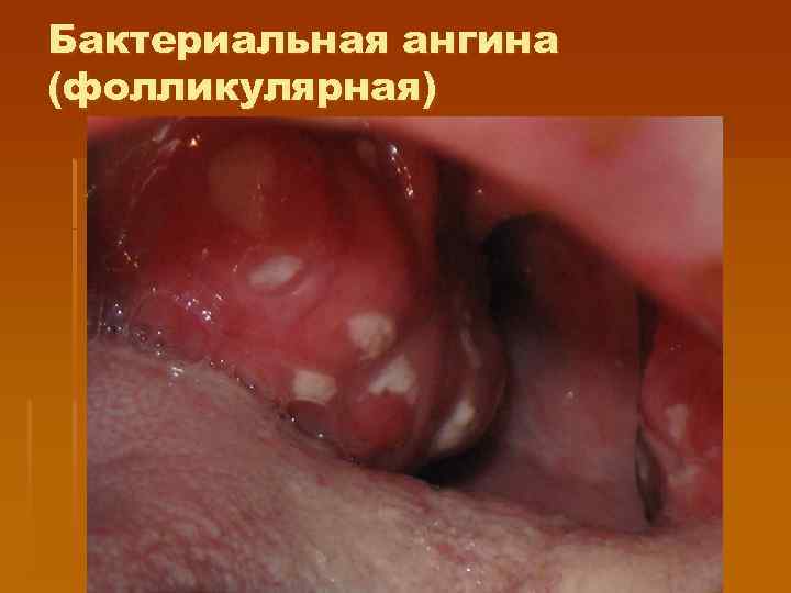 Бактериальная ангина (фолликулярная) 