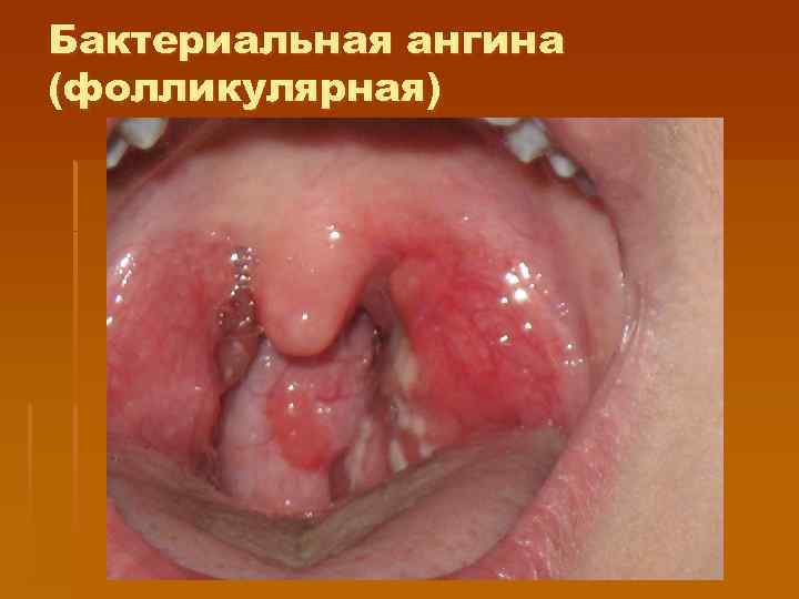 Бактериальная ангина (фолликулярная) 