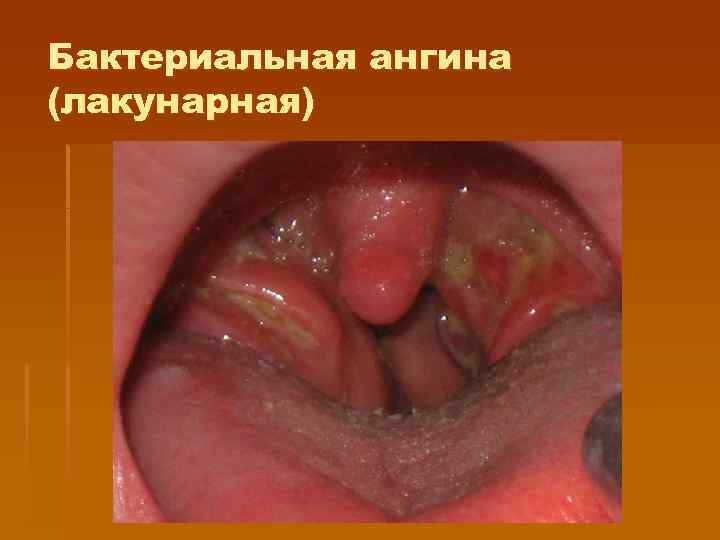Бактериальная ангина (лакунарная) 