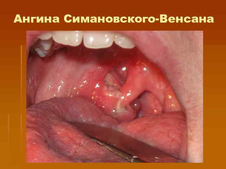 Ангина Симановского-Венсана 