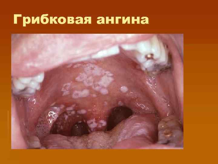 Грибковая ангина 
