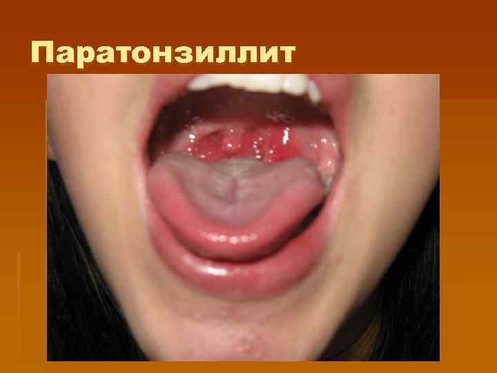 Паратонзиллит 