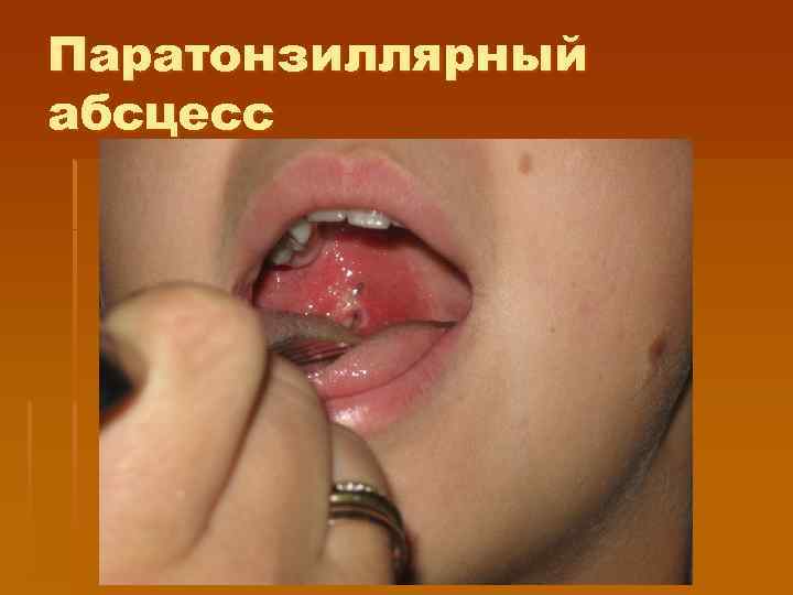Паратонзиллярный абсцесс 