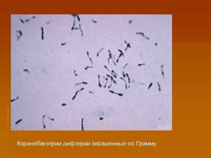 Коринебактерии дифтерии окрашенные по Грамму 