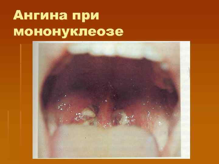 Ангина при мононуклеозе 