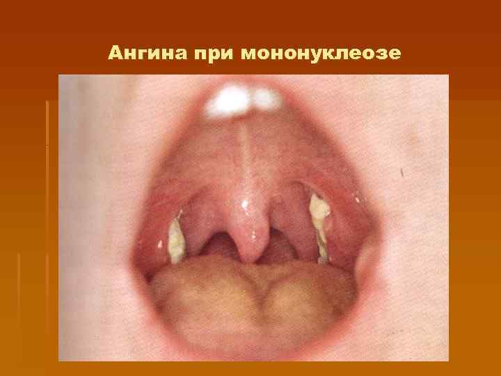 Ангина при мононуклеозе 