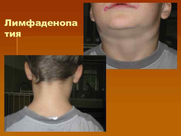 Лимфаденопа тия 