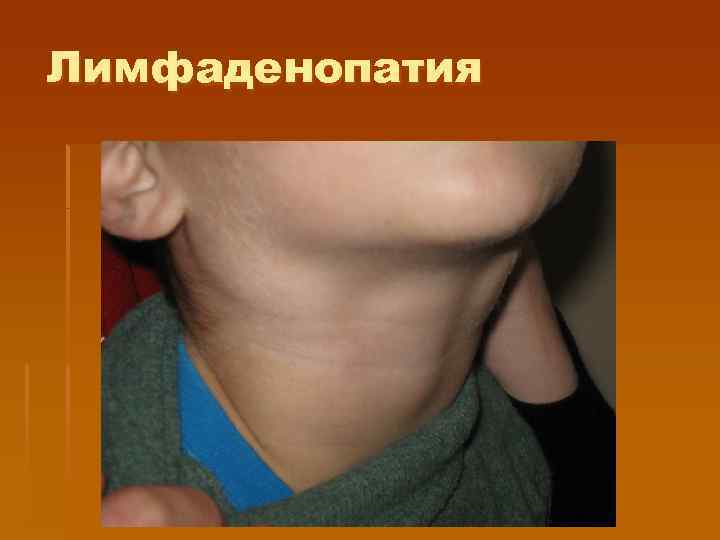Лимфаденопатия 