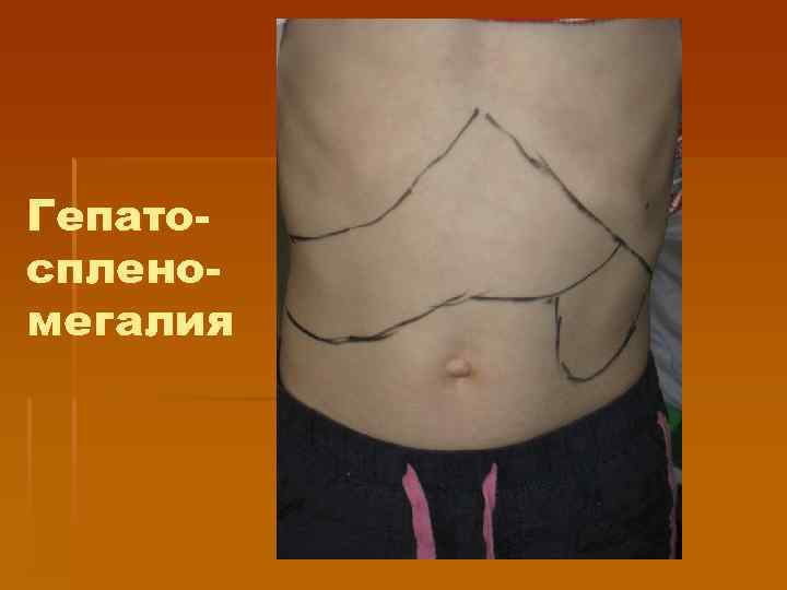 Гепатоспленомегалия 