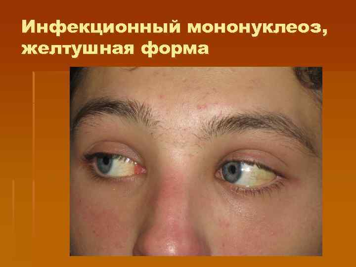 Инфекционный мононуклеоз, желтушная форма 