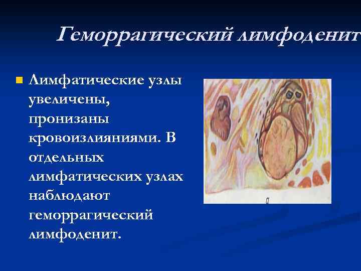 Геморрагический лимфоденит n Лимфатические узлы увеличены, пронизаны кровоизлияниями. В отдельных лимфатических узлах наблюдают геморрагический