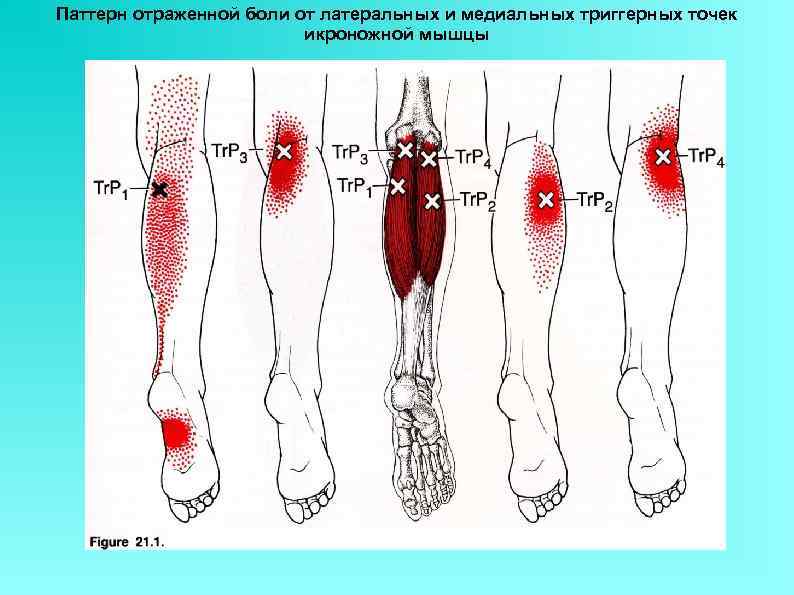 Паттерн отраженной боли от латеральных и медиальных триггерных точек икроножной мышцы 