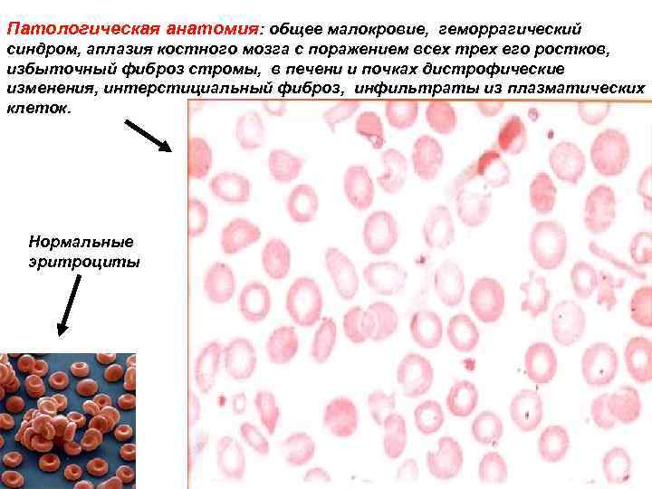 Патологическая анатомия: общее малокровие, геморрагический синдром, аплазия костного мозга с поражением всех трех его