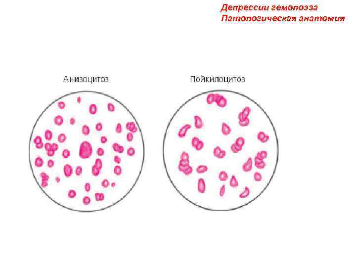 Депрессии гемопоэза Патологическая анатомия 