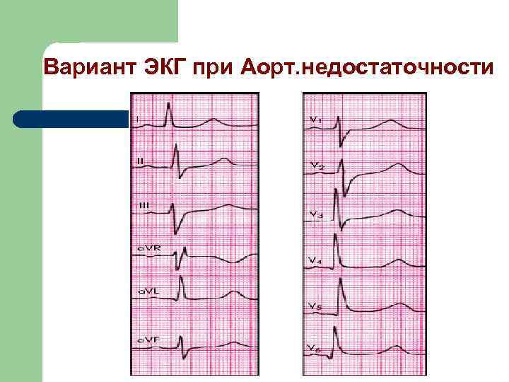 Вариант ЭКГ при Аорт. недостаточности 