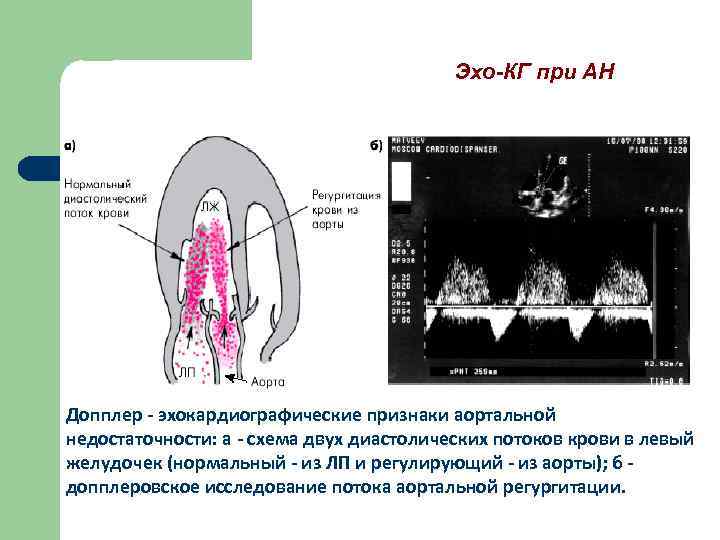 Эхо-КГ при АН Допплер - эхокардиографические признаки аортальной недостаточности: а - схема двух диастолических