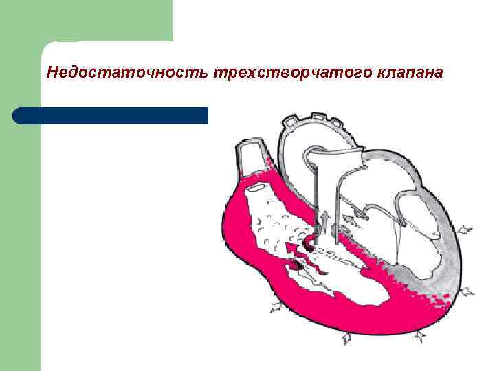 Недостаточность трикуспидального клапана презентация