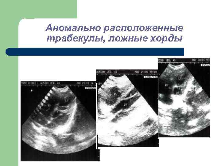 Аномально расположенные трабекулы, ложные хорды 