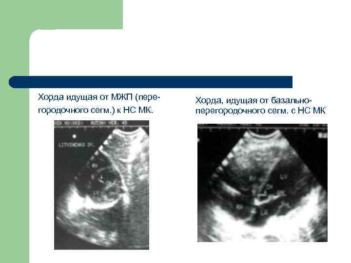 Хорда идущая от МЖП (перегородочного сегм. ) к НС МК. Хорда, идущая от базальноперегородочного