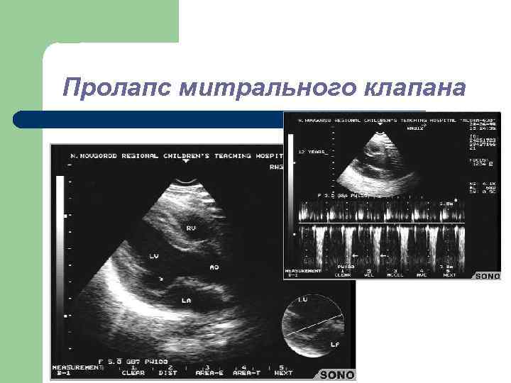 Пролапс митрального клапана 