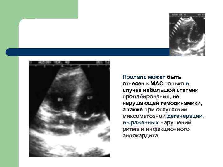 Пролапс может быть отнесен к МАС только в случае небольшой степени пролабирования, не нарушающей