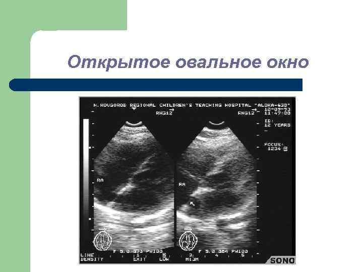 Овальное окно у новорожденных форум