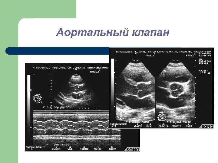 Аортальный клапан 