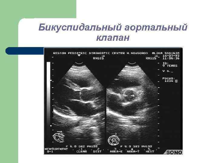 Бикуспидальный аортальный клапан 