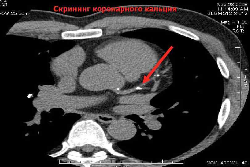 Кт скрининг коронарного кальция