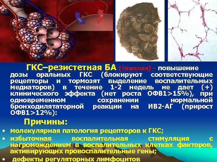  ГКС–резистетная БА (тяжелая) - повышение дозы оральных ГКС (блокируют соответствующие рецепторы и тормозят