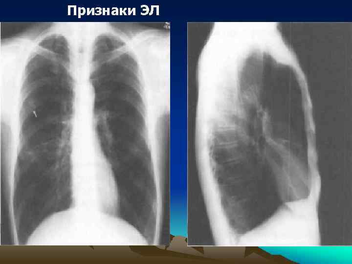 Признаки ЭЛ 