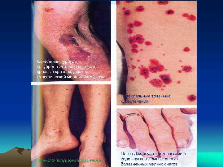 Сенильная пурпура – зазубренные темно-синеватокрасные кровоподтеки на атрофической морщинистой коже Петехиальные точечные кровотечения Пятнисто-популезная