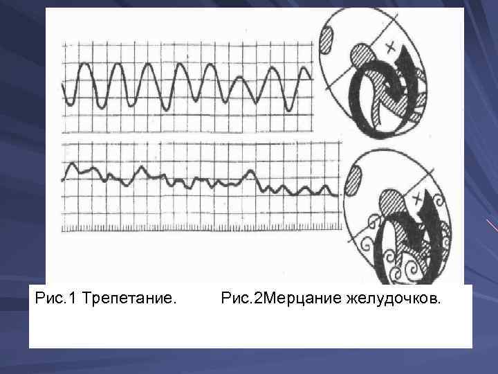 Рис. 1 Трепетание. Рис. 2 Мерцание желудочков. 