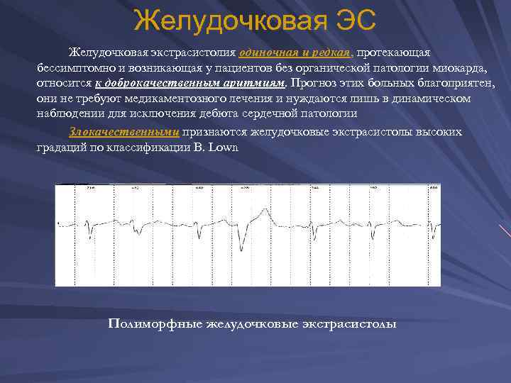 Желудочковая ЭС Желудочковая экстрасистолия одиночная и редкая, протекающая бессимптомно и возникающая у пациентов без