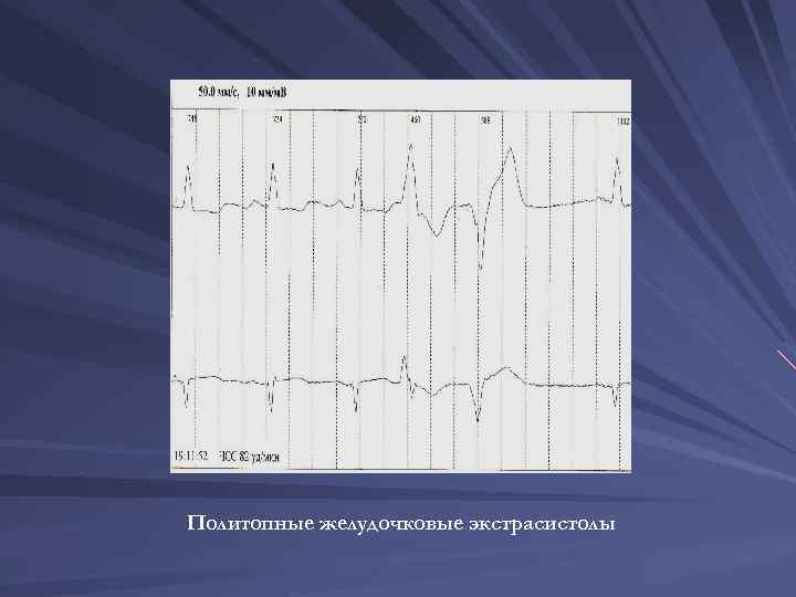 Политопные желудочковые экстрасистолы 