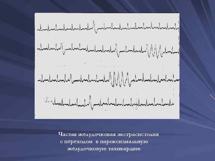 Частая желудочковая экстрасистолия с переходом в пароксизмальную желудочковую тахикардию 