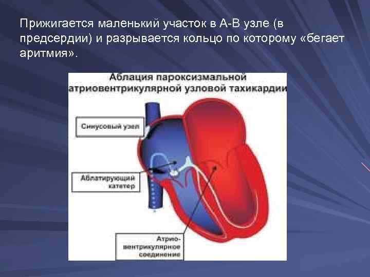 Прижигается маленький участок в А-В узле (в предсердии) и разрывается кольцо по которому «бегает