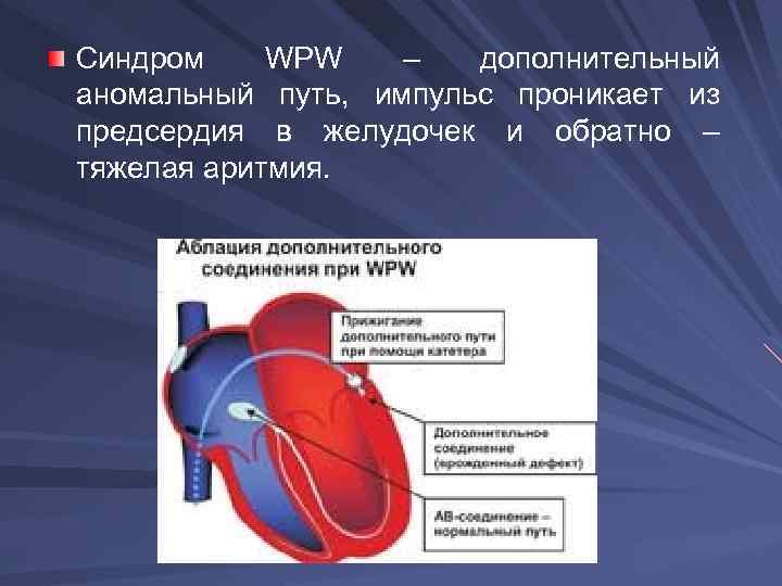 Синдром WPW – дополнительный аномальный путь, импульс проникает из предсердия в желудочек и обратно