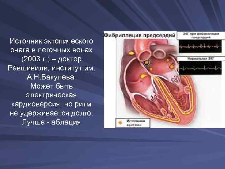 Источник эктопического очага в легочных венах (2003 г. ) – доктор Ревшивили, институт им.