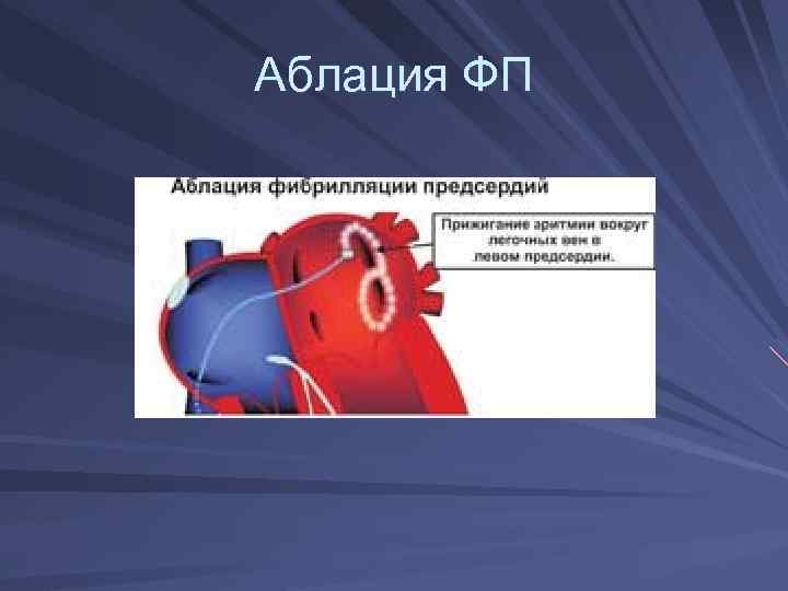 Аблация ФП 