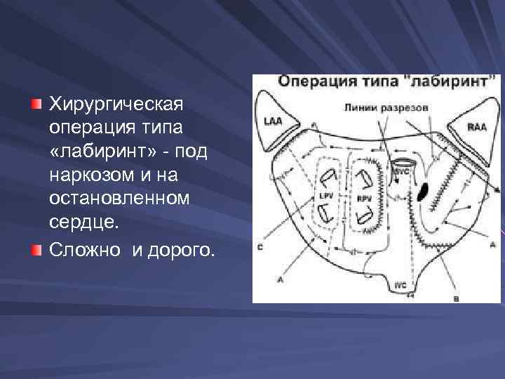 Хирургическая операция типа «лабиринт» - под наркозом и на остановленном сердце. Сложно и дорого.