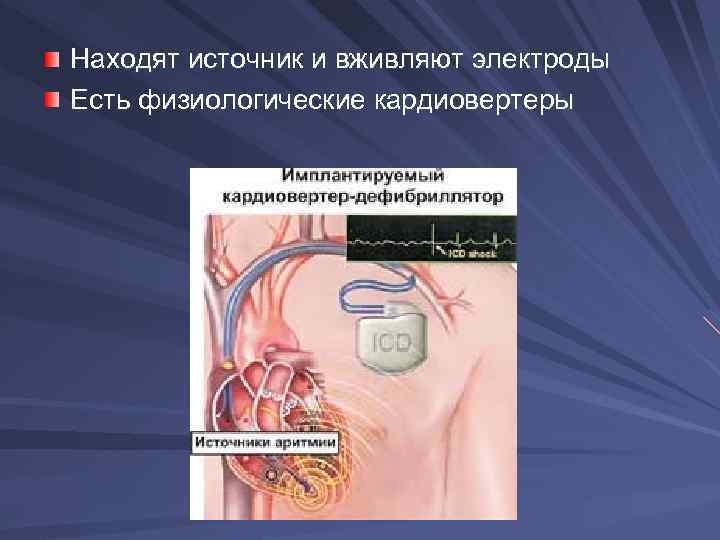 Находят источник и вживляют электроды Есть физиологические кардиовертеры 