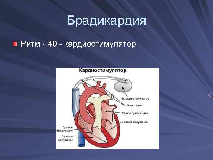 Брадикардия Ритм ‹ 40 - кардиостимулятор 